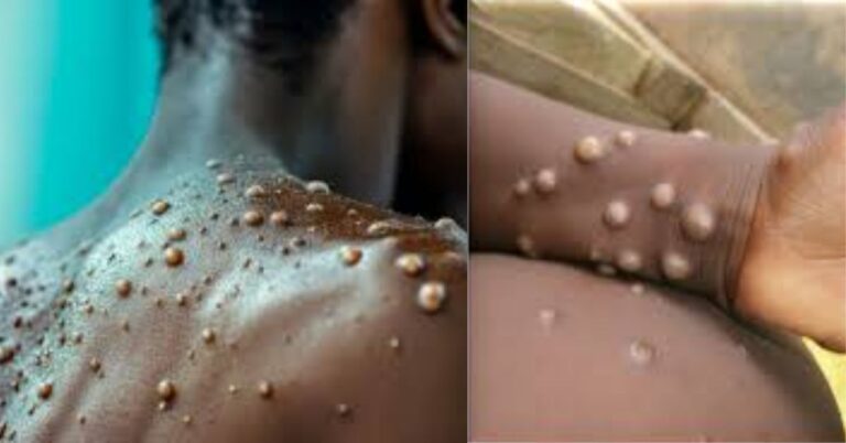 Mpox Crisis Deepens: Kenya Confirms 314 Cases Across 22 Counties