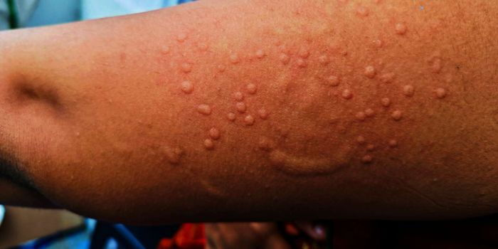 Kenya Battles Rising Mpox Cases as Outbreak Spreads to 22 Counties